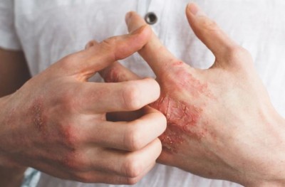 Know these 6 signs of diabetes found in skin
