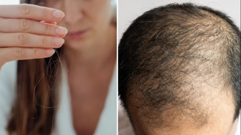 Why is Hair Falling Out at a Young Age? Understand the Reasons