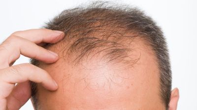 Follow these tips to get rid of Baldness