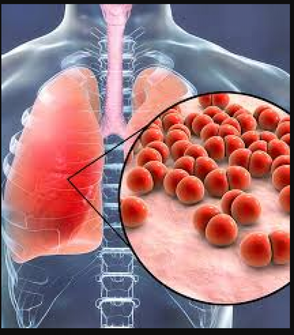 Immediate cure for pneumonia is possible, know its symptoms and prevention