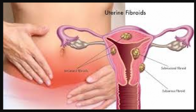 महिलाओ में fibroid या बच्चेदानी के गांठ से जुडी होती है ये अन्य समस्याए, जाने
