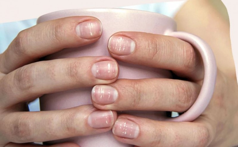 Why Are There White Marks on Nails? Discover the Reasons Here