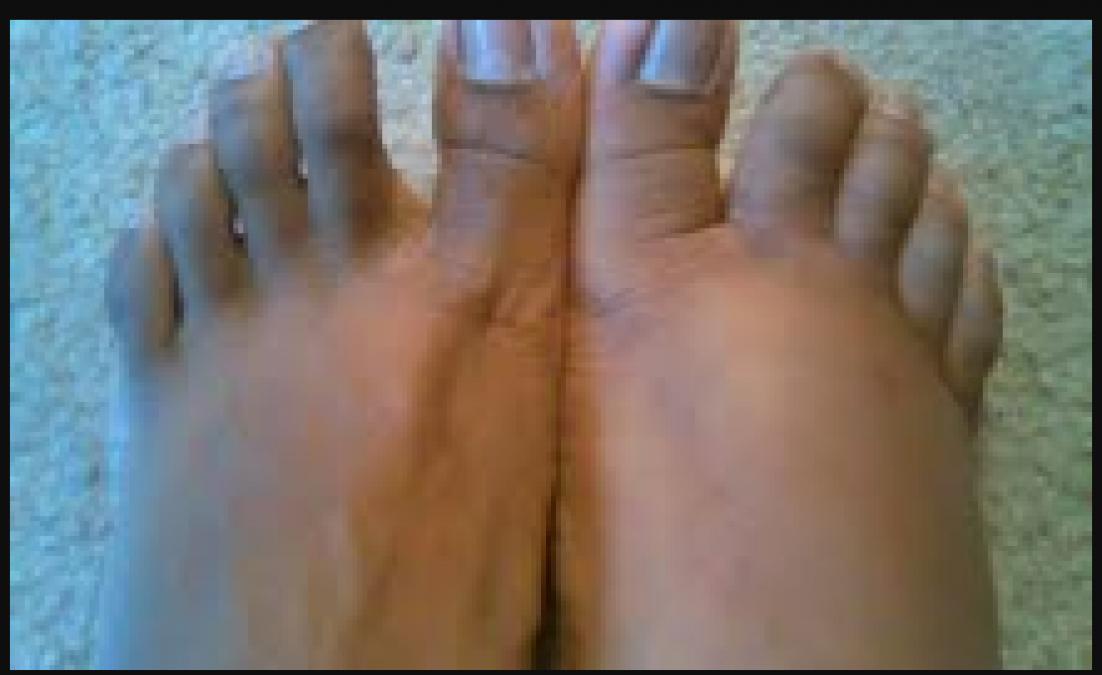 If you have swelling in hands and feet then try these measures, will give you relief