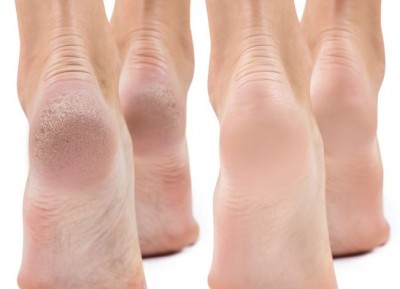 Eliminate Ankle Dryness with These Effective Tricks