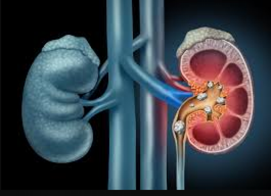 This cure will eliminate kidney stone disease, read here