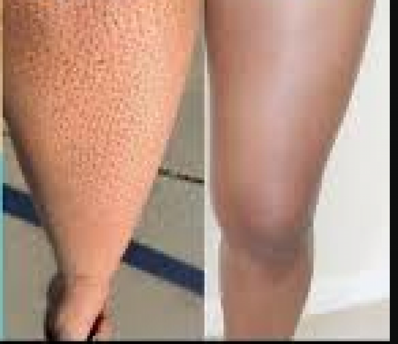 Is strawberry legs the reason for black dots in your feet? know reason