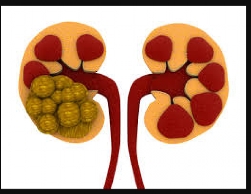 These symptoms indicate kidney stones, be careful after knowing