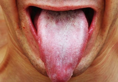 How to Clean a Dirty Tongue for Improved Health