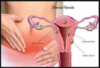 These are the symptoms of the lumps in the uterus and its treatment