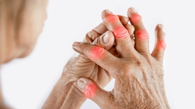 What causes arthritis, know the reason