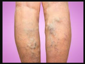 Varicose veins is a dangerous disease, this is the cure