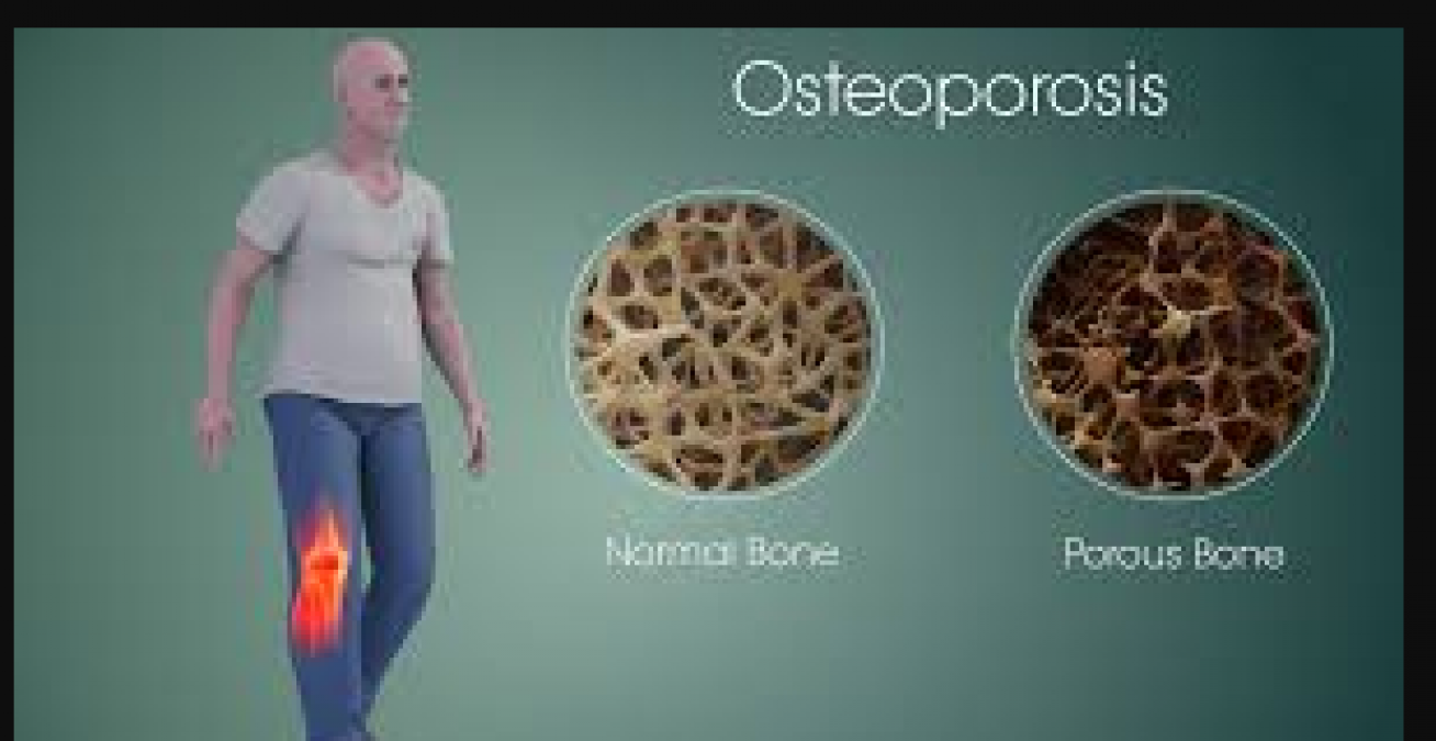 Osteoporosis Day: These things are responsible for weak bones