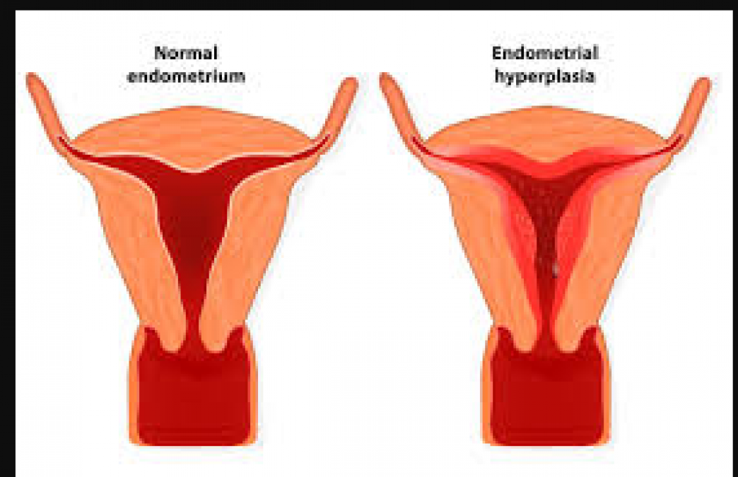 Endometriosis affects the fertility of women, know here!