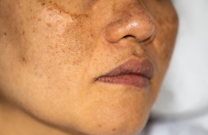 Troubled by Pigmentation? Here's How to Get Rid of It