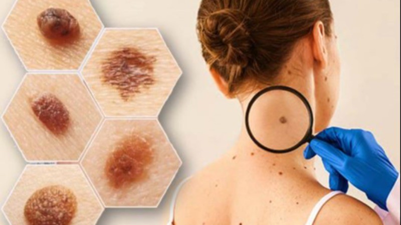 Increasing Pollution Raises the Risk of Skin Cancer: How to Prevent It