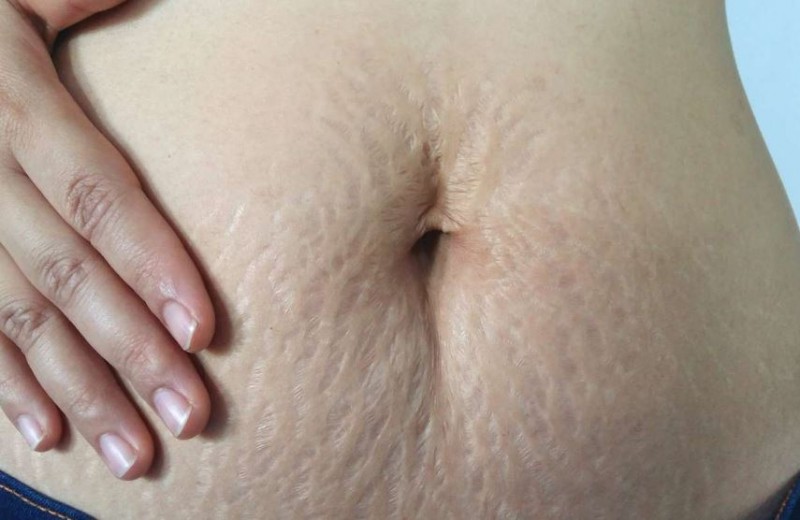 Keep These Things in Mind During Pregnancy to Prevent Stretch Marks After Delivery