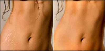 Amazing Tips To Reduce Stretch Marks After Losing Weight