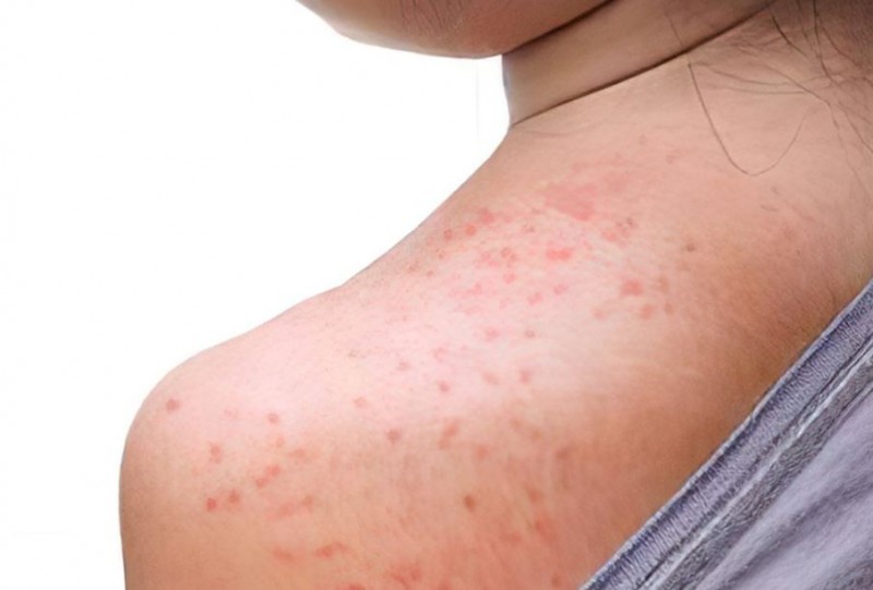 Understanding and Treating Heat Rash in Adults