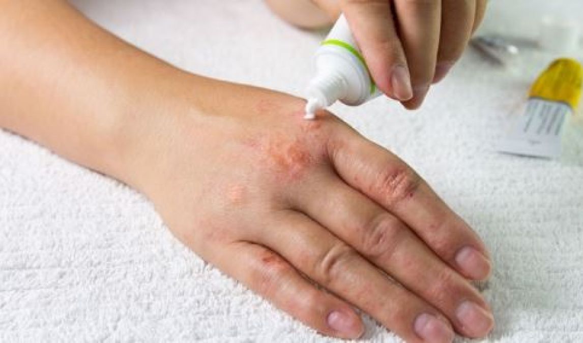Know how to overcome the problem of ringworm in the rainy season