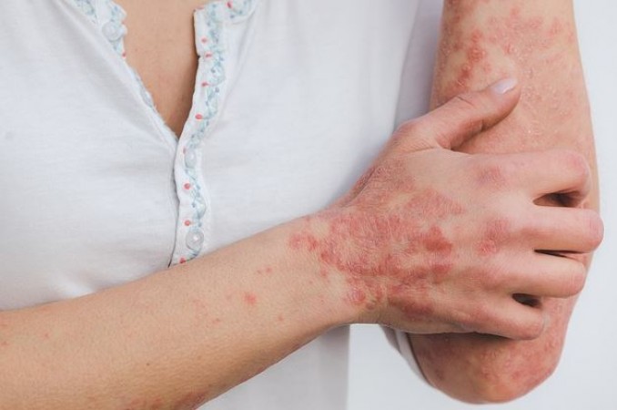 Study Reveals Link Between Skin Disease and Increased Intestinal Inflammation