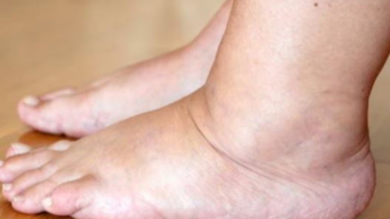 Swelling in the Feet Due to Diabetes