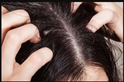 Adopt these tips to avoid hair scalp itching