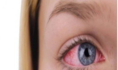 If the eyes turn red from the sun in the heat, then adopt these home remedies.