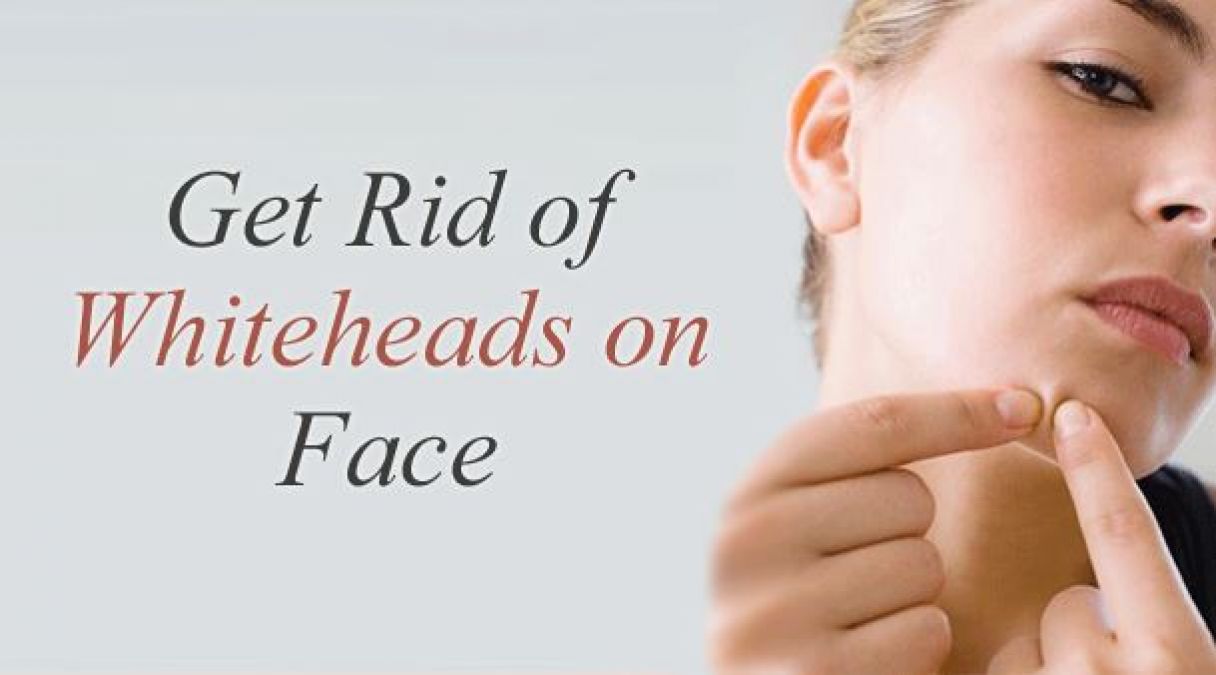 Quick Home Remedies to Get Rid of Whiteheads from Face