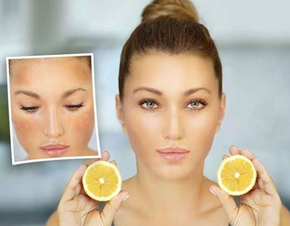 Easy Remedies for Getting Relief from Dark Spots