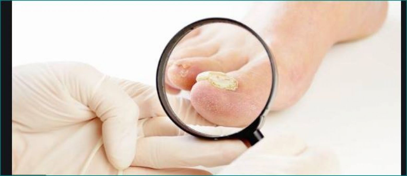 Do this home remedy to get rid of fungal infection in feet