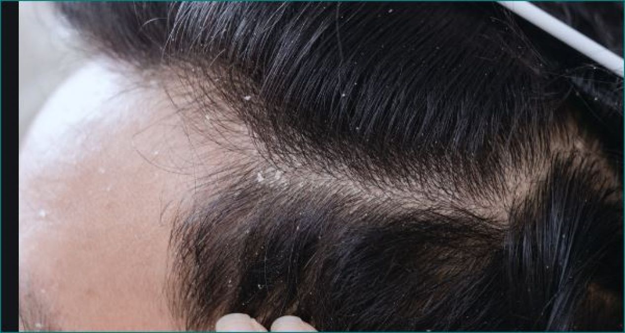 Try these home remedies to treat dandruff naturally