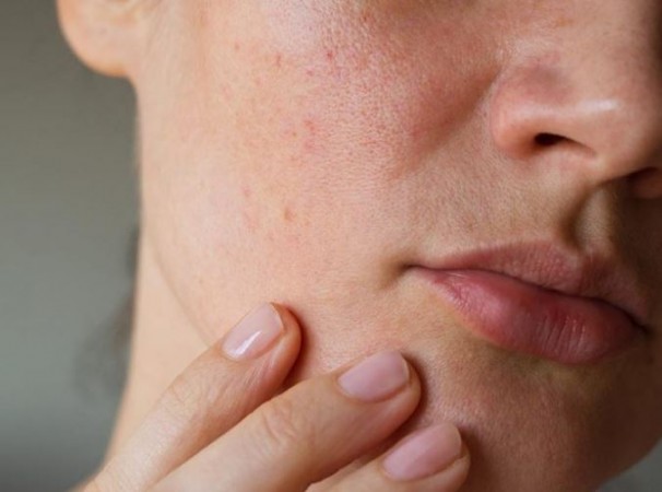 Follow these home remedies to get rid of open pores