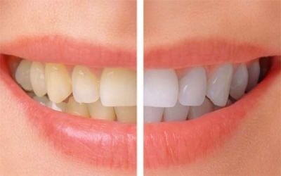 Simple Ways to Naturally Whiten Your Teeth at Home