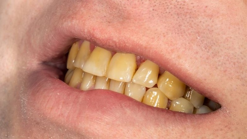 How to Get Rid of Yellow Teeth? Adopt These Effective Remedies