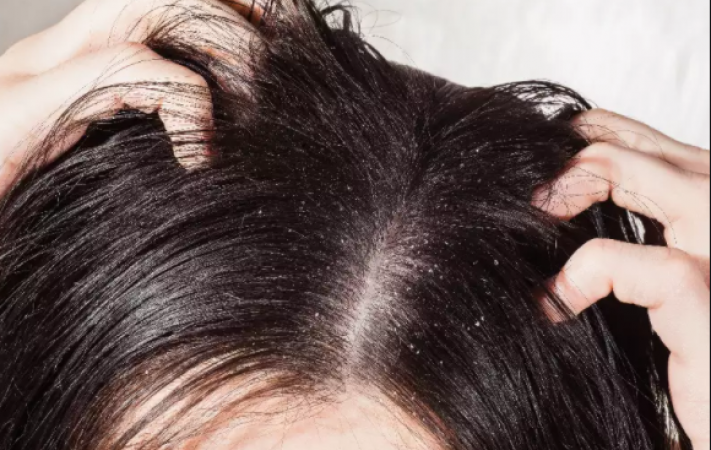 If you are troubled by dandruff on rainy days, then follow this home remedy!