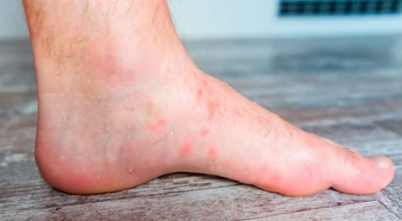 How to Prevent Fungal Infections in Feet Caused by Rainwater