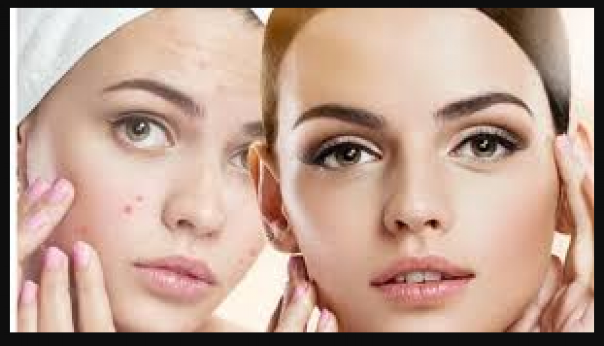 Follow these household tips to make the pimples easily disappear from face
