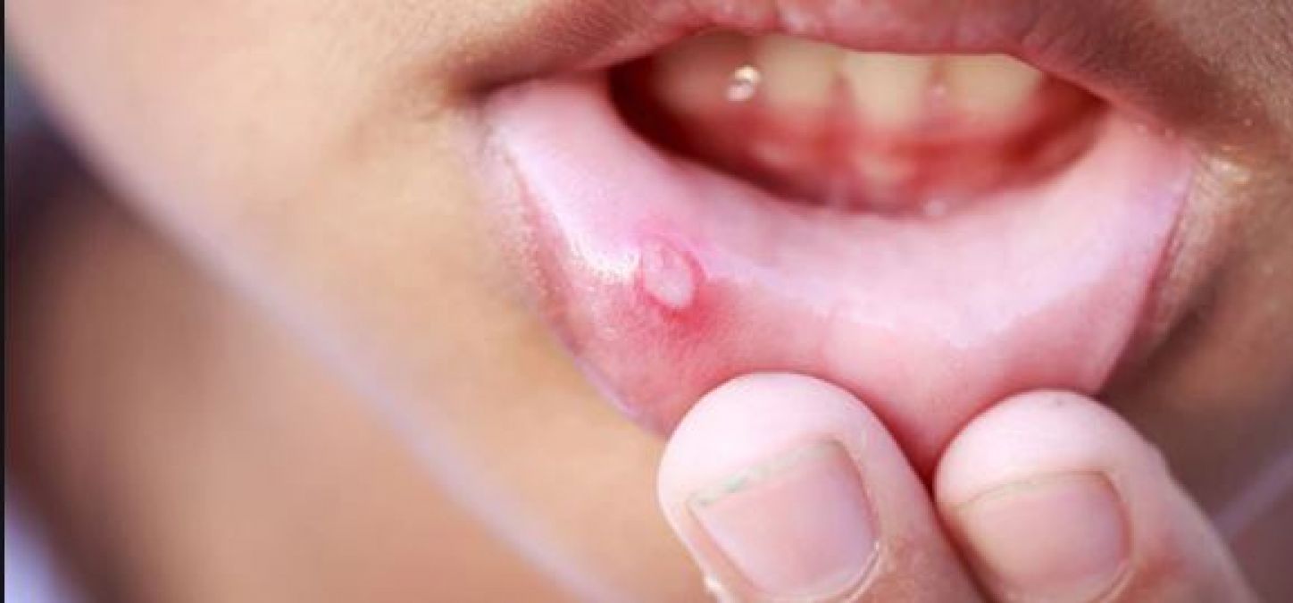 Ghee, turmeric and these home remedies will make mouth ulcers disappear
