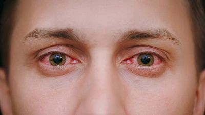 Eye फ्लू के लक्षण जानकर तुरंत ऐसे करें उनका इलाज