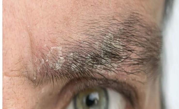 Dandruff has happened on the eyebrows, so adopt these home remedies