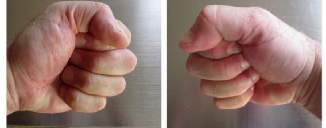 If there is swelling in the hands, try this home remedy