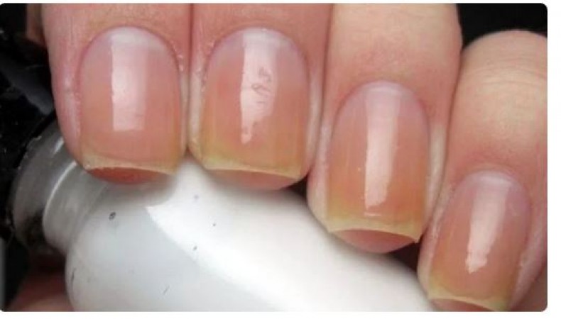 Remove the yellowing of nails with these home remedies