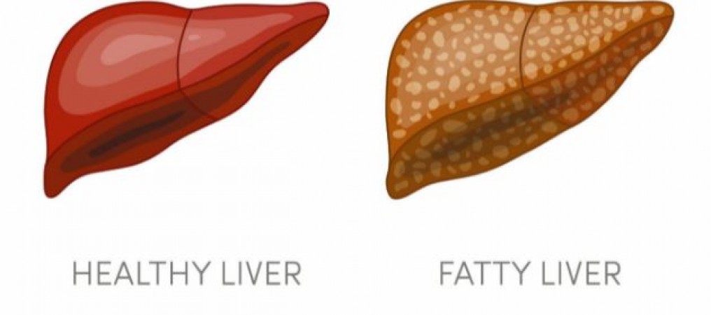 If you are suffering from fatty liver, add these things to milk from today and start drinking