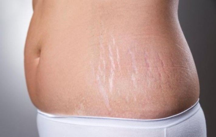Remove Stretch Marks with These Easy Home Remedies: A Simple Approach