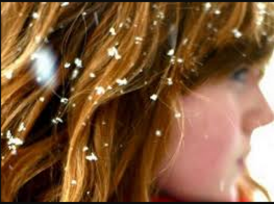 Adopt this tip to get rid of dandruff for forever
