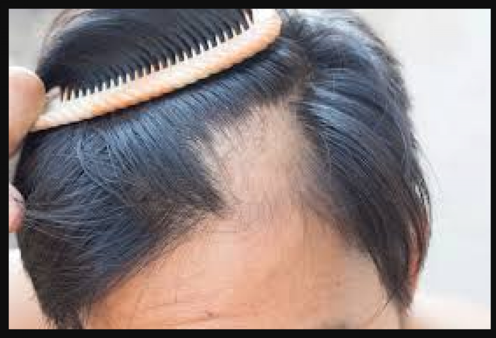 Problem of hair fall increases in winter, know how to get rid of it