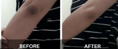 These home remedies will remove blackness from elbows to knees