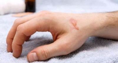 If there are burn marks left on the body, then follow these home remedies