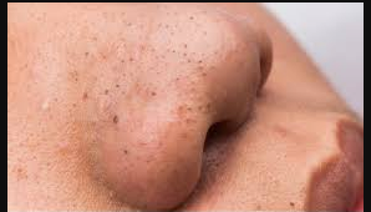 Try these home remedies to get rid of stubborn blackheads