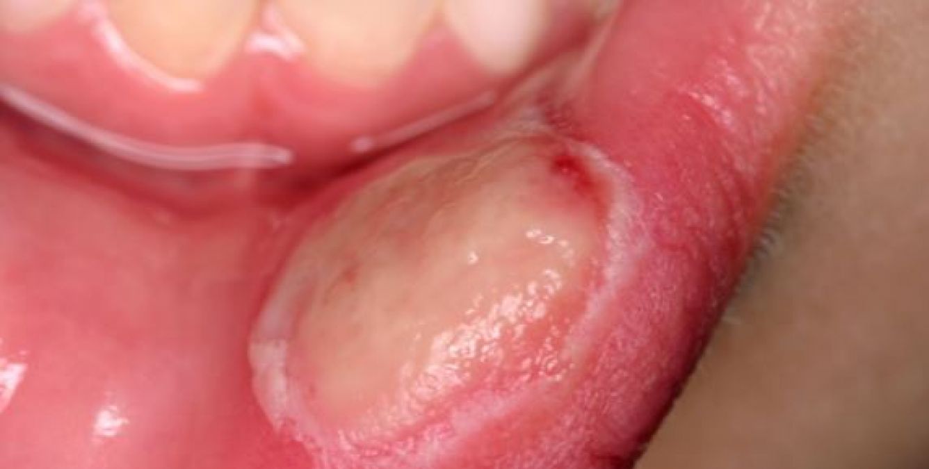 If there are blisters in the mouth, take this home remedy to remove them